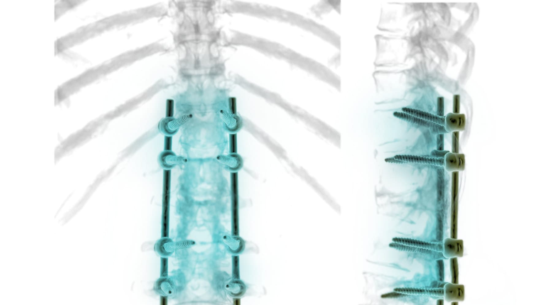 Spinal fusion illustration